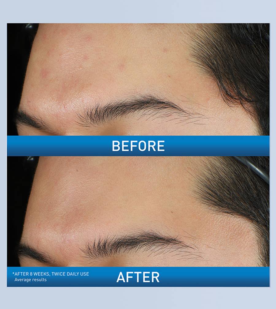 Acne Foaming Cream Wash - Image 4